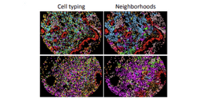 A deep learning analysis pipeline for multiplex imaging identifies spatial features associated  with clinical outcome in colorectal cancer