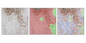 Deep Learning-Based Evaluation of PD-L1 Immunohistochemistry-Stained Slides for Robust Tumor Proportion Scoring Enables Better Categorization of Non-Small-Cell Lung Cancer Cases