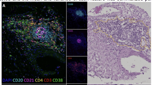 Identification of tertiary lymphoid structures from H&E slides using deep learning analysis of nuclear morphology is associated with favorable survival in colorectal cancer patients